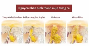 nguyen-nhan-mun-trung-ca-1