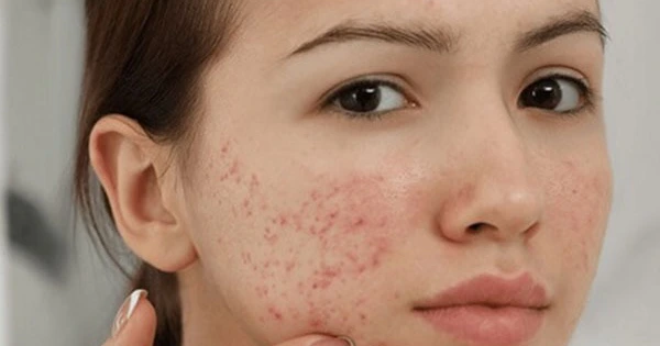 nguyen-nhan-mun-trung-ca-2